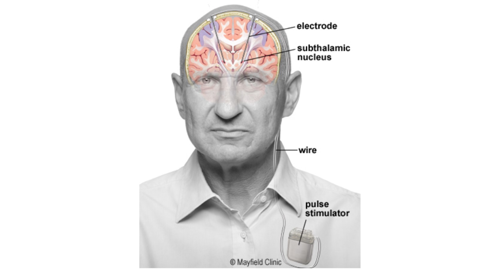 Estrutura de estimulación cerebral profunda