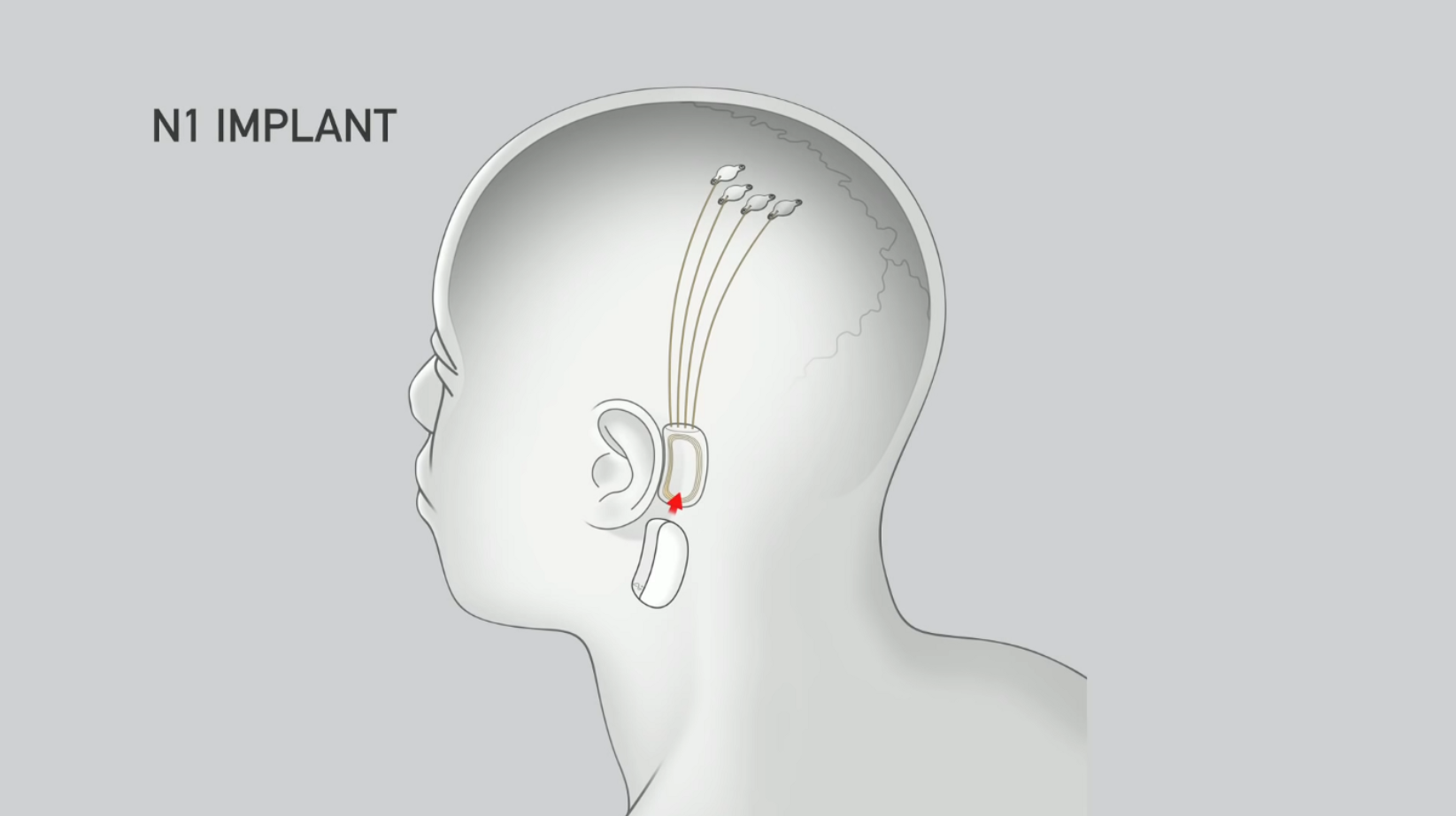 Neuralink N1 Chip Implant